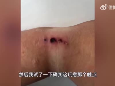 米动青春客服回应佩戴电子手表手腕被电灼伤：之前也接到过相关投诉，这种现象很少